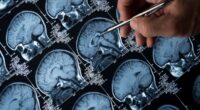 Alzheimer’s ‘wonder drug’ slows progression of disease by four years - and could even reverse it