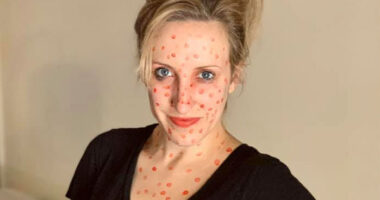 Anti-Vaxxer Mocks Measles With Her Halloween Costume, Gets Shut Down By A Comment From A Medical Professional