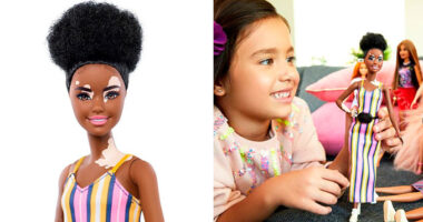Barbie Celebrates Diversity By Creating Differently-Abled Dolls With Vitiligo And No Hair That Come In 35 Different Skin Tones