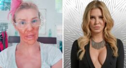 Brandi Glanville Reveals New Smile After $130K Health Battle And Face-Disfiguring Parasite