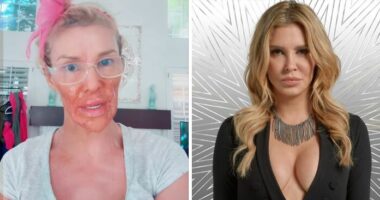 Brandi Glanville Reveals New Smile After $130K Health Battle And Face-Disfiguring Parasite
