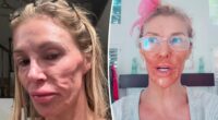 Brandi Glanville names her facial parasite after her ‘Real Housewives’ nemesis