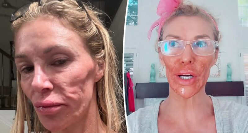 Brandi Glanville names her facial parasite after her ‘Real Housewives’ nemesis