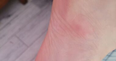 Hey Pandas, What Was The Worst Place You’ve Gotten Bitten By A Bug Or Insect