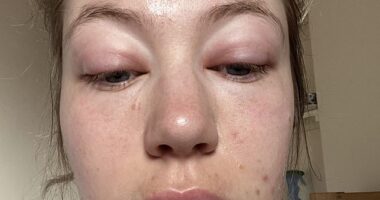 Ellen Swarbrick, from Wilmslow, Cheshire, started waking up with a 'puffy' face in spring 2022, but had always assumed it was just the result of hay fever