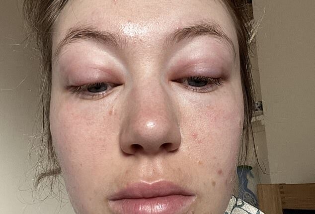 Ellen Swarbrick, from Wilmslow, Cheshire, started waking up with a 'puffy' face in spring 2022, but had always assumed it was just the result of hay fever