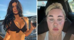 “Love The Lips”: Amanda Bynes Shocks Fans With Transformation After Revealing New Cosmetic Procedures