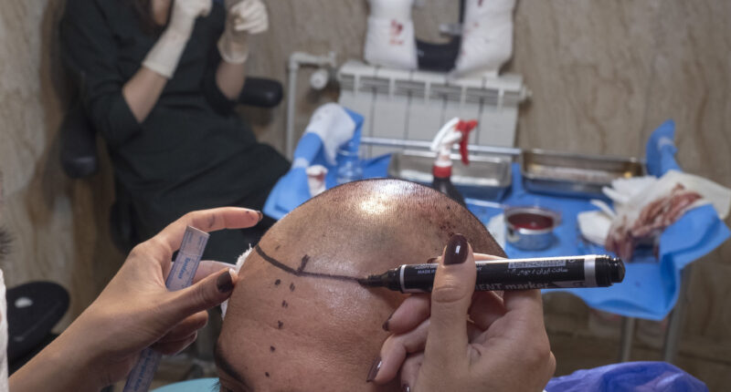 Hair Transplant Surgery Martyn Latchman Man England Dies During Prep Phase In Turkey