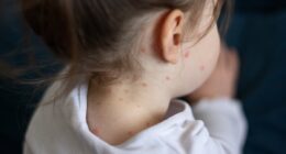 Millions of children to receive chickenpox vaccine on NHS