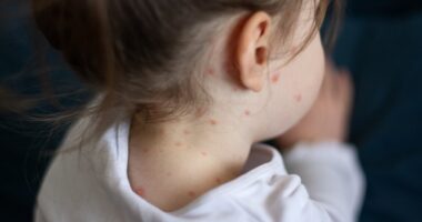 Millions of children to receive chickenpox vaccine on NHS