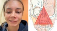 Mom Ends Up in Urgent Care After Popping Pimple In The “Triangle Of Death”