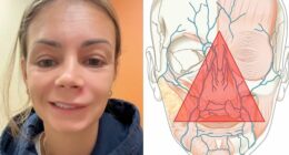 Mom Ends Up in Urgent Care After Popping Pimple In The “Triangle Of Death”