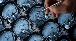 The mineral that could protect against Alzheimer’s disease