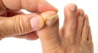 Thickened or damaged toenails can be agonising, limit mobility and trigger dangerous infections