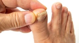 Thickened or damaged toenails can be agonising, limit mobility and trigger dangerous infections