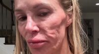 Brandi Glanville has claimed that a parasite has left her with facial disfigurement. She spent over $113K trying to remove the hard lumps on her cheekbone, jaw, and neck