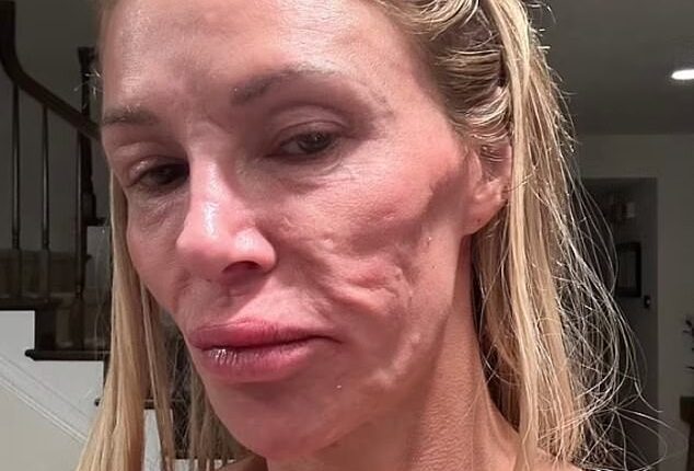 Brandi Glanville has claimed that a parasite has left her with facial disfigurement. She spent over $113K trying to remove the hard lumps on her cheekbone, jaw, and neck