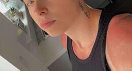 Shannon Armer, 25, from the UK, spent just two hours tanning and developed severe sun poisoning that left her bed bound for days