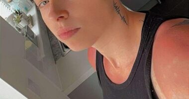 Shannon Armer, 25, from the UK, spent just two hours tanning and developed severe sun poisoning that left her bed bound for days
