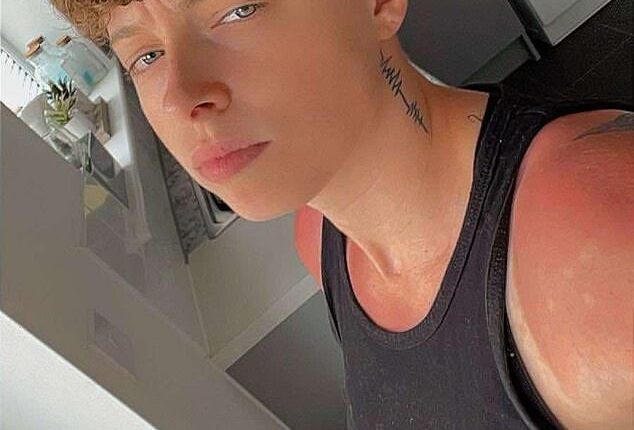 Shannon Armer, 25, from the UK, spent just two hours tanning and developed severe sun poisoning that left her bed bound for days