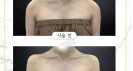 Also called 'trap tox' the procedure, which elongates the neck and releases tension for a slimmed down look is going viral after K-pop star Blackpink promoted the look in her song Jennie