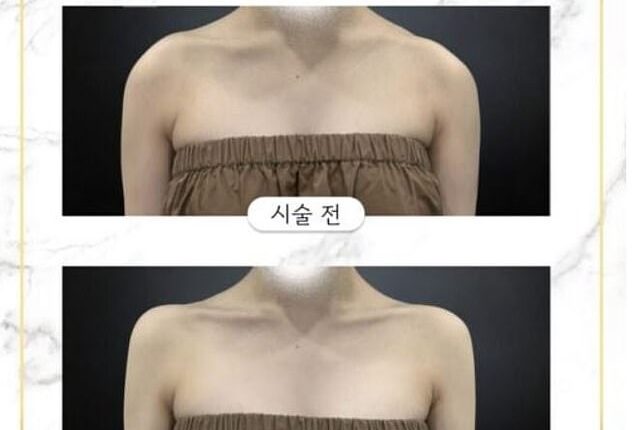 Also called 'trap tox' the procedure, which elongates the neck and releases tension for a slimmed down look is going viral after K-pop star Blackpink promoted the look in her song Jennie
