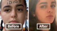 “Changed My Life!” 80 Photos Before And After Tattoo Removal
