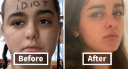 “Changed My Life!” 80 Photos Before And After Tattoo Removal