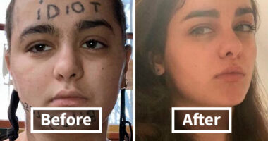 “Changed My Life!” 80 Photos Before And After Tattoo Removal