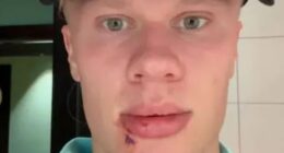 Manchester City striker Erling Haaland required three stitches after suffering a bleeding mouth