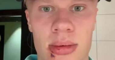 Manchester City striker Erling Haaland required three stitches after suffering a bleeding mouth