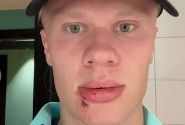 Manchester City striker Erling Haaland required three stitches after suffering a bleeding mouth