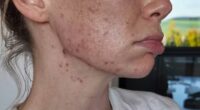 Georgia Toffolo has revealed the 'relentless' reality behind her acne battle aged 30 as she shared a candid clip to Instagram on Monday