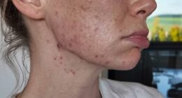 Georgia Toffolo has revealed the 'relentless' reality behind her acne battle aged 30 as she shared a candid clip to Instagram on Monday