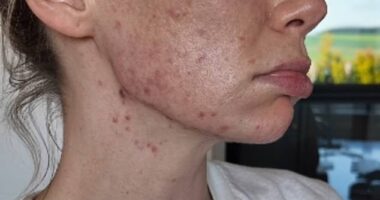 Georgia Toffolo has revealed the 'relentless' reality behind her acne battle aged 30 as she shared a candid clip to Instagram on Monday