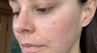 Emma North suffered from the skin condition perioral dermatitis, or what she calls the ‘beauty editor’s curse’, due to testing an abundance of free product samples, treatments and new wave facials for her job