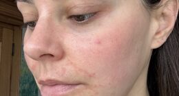 Emma North suffered from the skin condition perioral dermatitis, or what she calls the ‘beauty editor’s curse’, due to testing an abundance of free product samples, treatments and new wave facials for her job