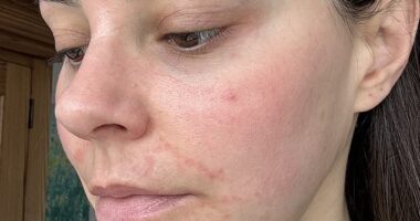 Emma North suffered from the skin condition perioral dermatitis, or what she calls the ‘beauty editor’s curse’, due to testing an abundance of free product samples, treatments and new wave facials for her job