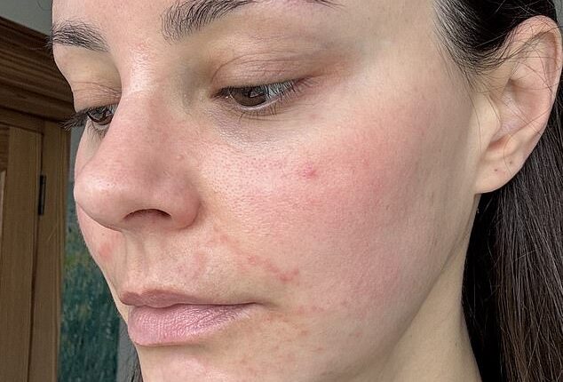 Emma North suffered from the skin condition perioral dermatitis, or what she calls the ‘beauty editor’s curse’, due to testing an abundance of free product samples, treatments and new wave facials for her job