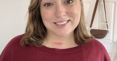 Hayley Black has been left with a scar on her neck from the life-saving operation