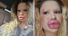 Woman With ‘World’s Biggest Lips’ Shares What She Looked Like Before $26K Extreme Surgeries