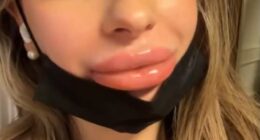 Malene Mauer (pictured) experienced a dramatic and painful reaction when she had lip filler - but the beauty practitioner who carried out the procedure blamed it on her menstrual period