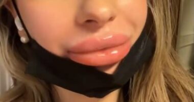 Malene Mauer (pictured) experienced a dramatic and painful reaction when she had lip filler - but the beauty practitioner who carried out the procedure blamed it on her menstrual period