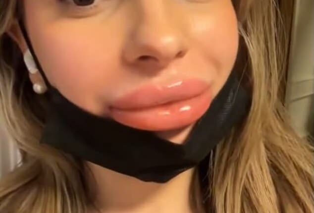 Malene Mauer (pictured) experienced a dramatic and painful reaction when she had lip filler - but the beauty practitioner who carried out the procedure blamed it on her menstrual period
