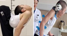 ‘Folded Boy’ Who Was Bent At 180 Degrees For Most Of His Life Stuns With ‘Magical’ Transformation
