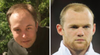 19 Celebrities Who Look Noticeably Better After Hair Transplants