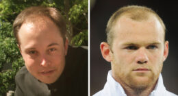 19 Celebrities Who Look Noticeably Better After Hair Transplants