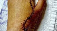 Saurabh Anand's hand after allegedly being attacked by a machete wielding thug