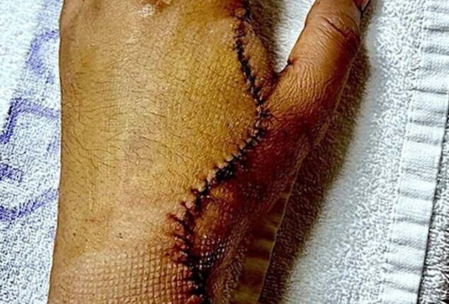 Saurabh Anand's hand after allegedly being attacked by a machete wielding thug