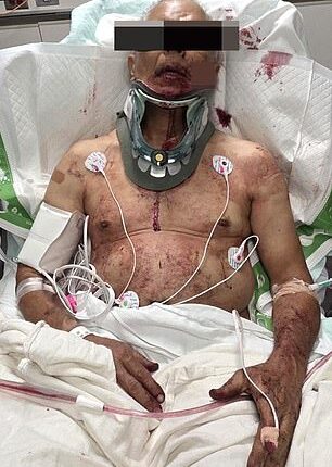 Perry Tole, a grease truck driver, is seen lying in a hospital bed, covered in blood with a huge gash on his face and a brace around his neck